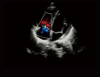 三尖瓣反流，CW 模式