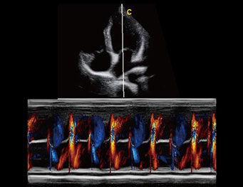心尖四腔心， 彩色M模式