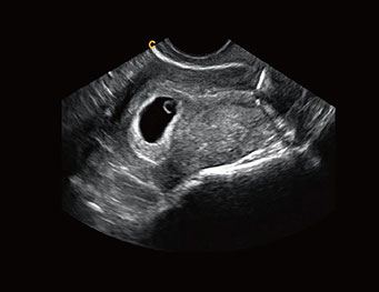 早孕，B 模式