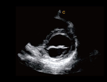 二尖瓣短轴，自由M模式