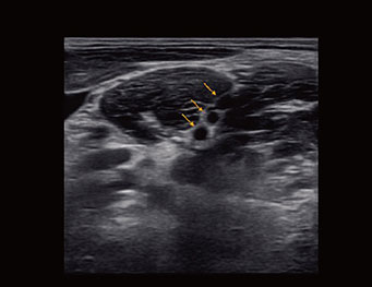 臂丛神经，B 模式