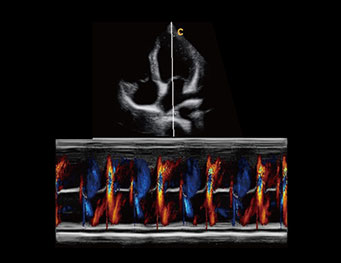 心尖四腔心，彩色M模式