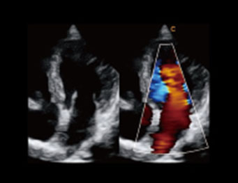 主动脉反流，BBC 模式