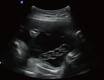 胎儿脐带，B 模式