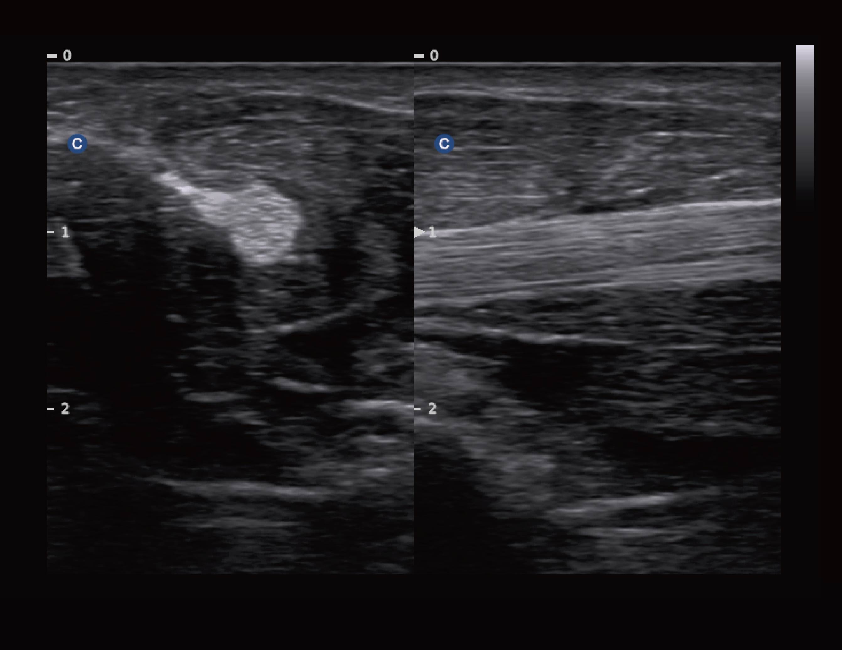 拇长屈肌腱，B模式