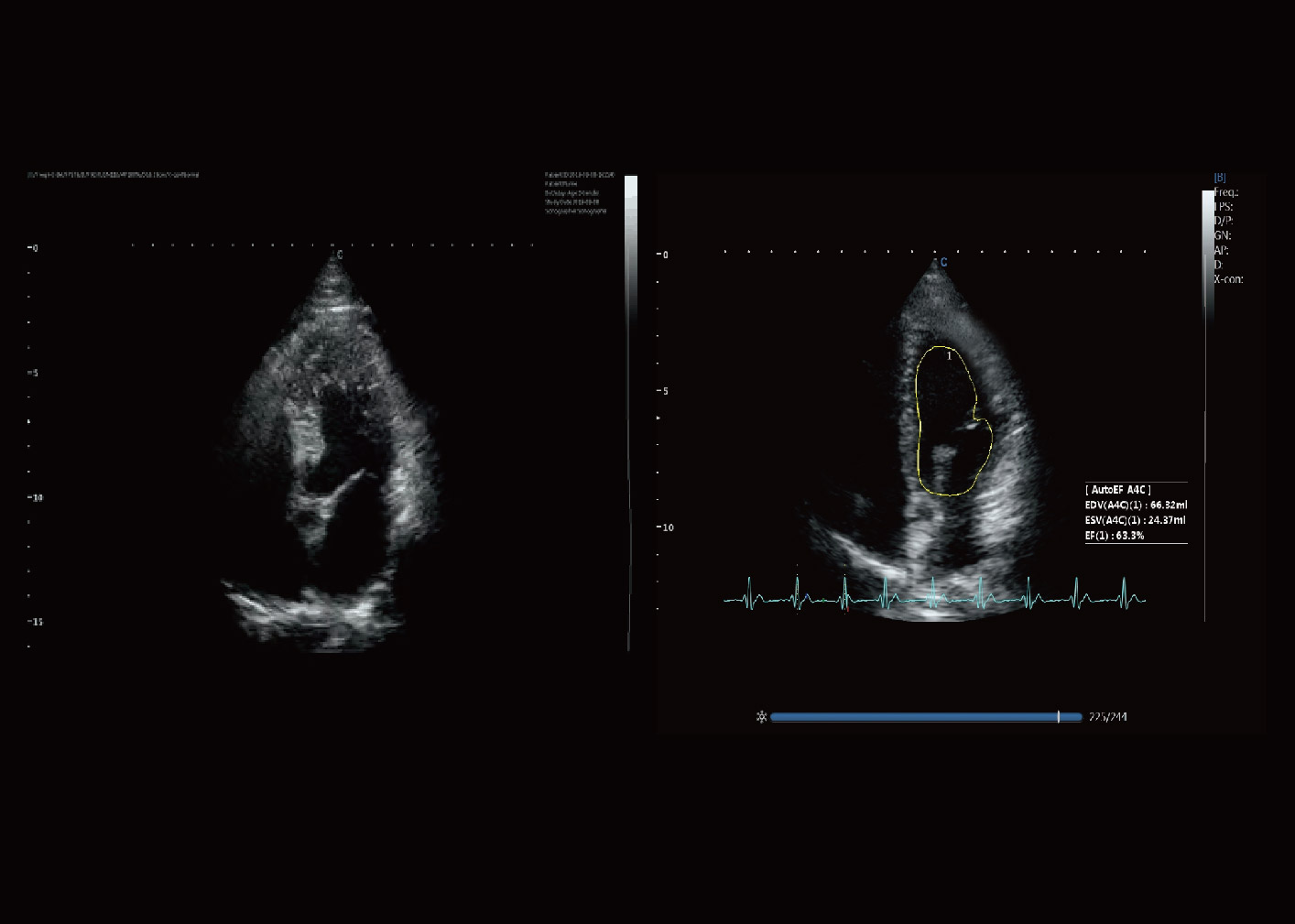 射血分数（EF）