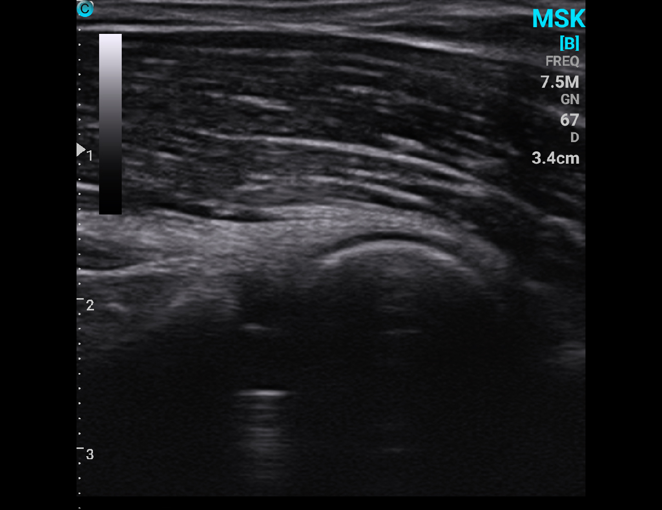 肩部，B 模式
