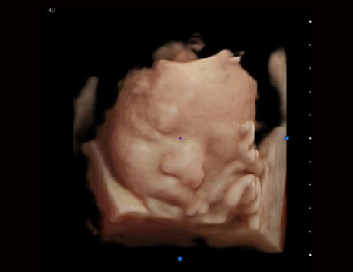 胎儿，4D模式