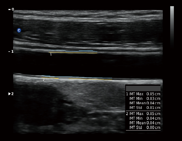 血管，IMT自动检测模式