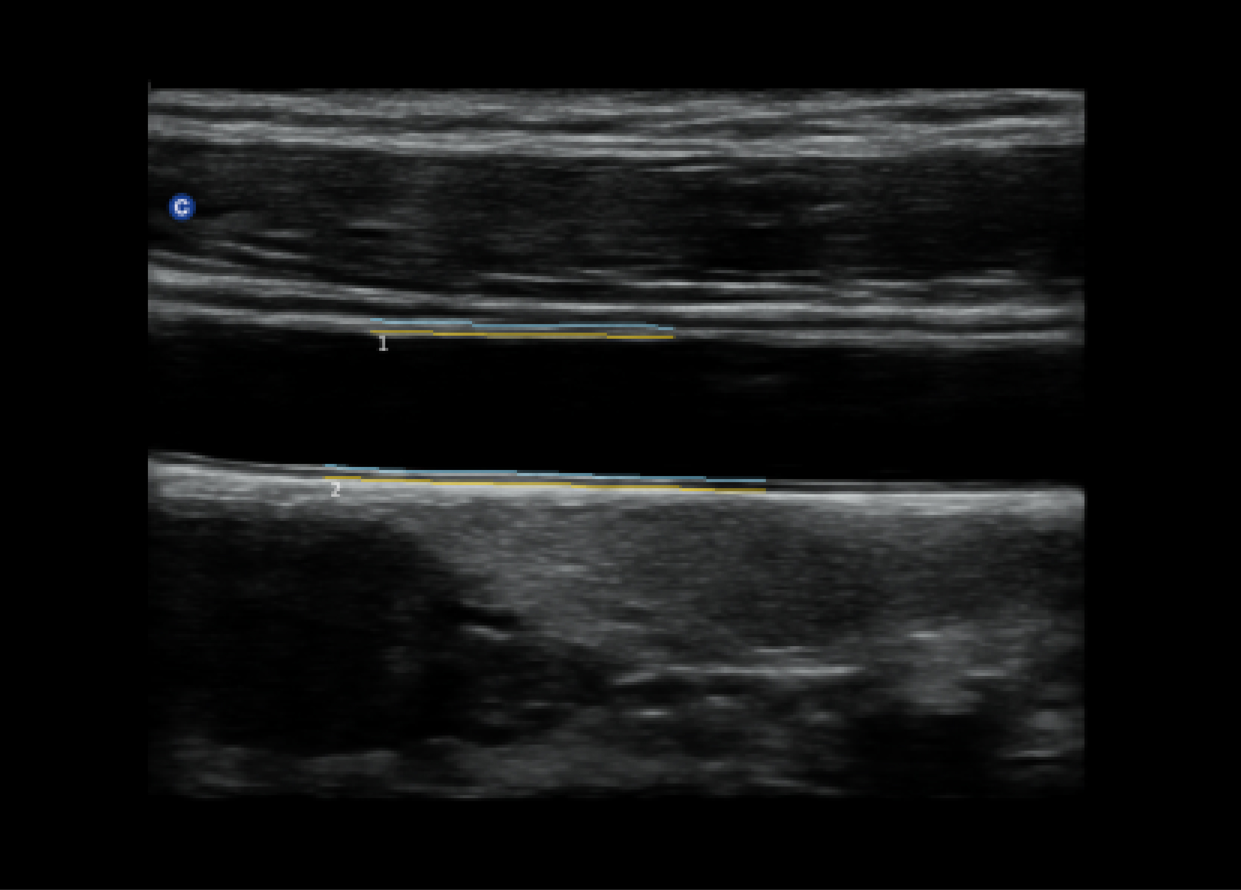 IMT内膜自动测量